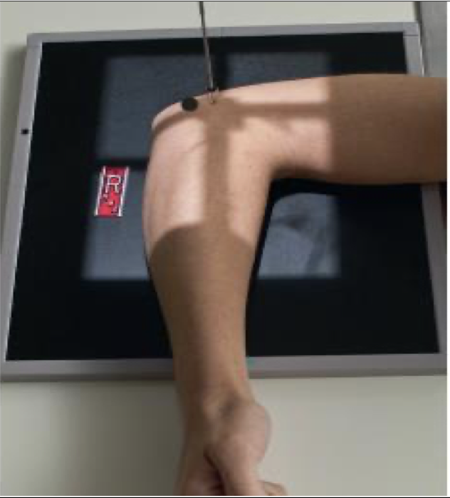 <p>Patient Position </p><p class="p1"><span data-name="black_small_square" data-type="emoji">▪</span><span style="line-height: normal;"><span> </span></span>Sitting alongside or end of table</p><p class="p1"><span data-name="black_small_square" data-type="emoji">▪</span><span style="line-height: normal;"><span> </span></span>Humerus abducted</p><p class="p1"><span data-name="black_small_square" data-type="emoji">▪</span><span style="line-height: normal;"><span> </span></span>Entire upper limb must be at same height</p><p class="p1"></p><p class="p1">Part Position</p><p class="p1"><span data-name="black_small_square" data-type="emoji">▪</span><span style="line-height: normal;"><span> </span></span>Elbow flexed 90</p><p class="p1"><span data-name="black_small_square" data-type="emoji">▪</span><span style="line-height: normal;"><span> </span></span>If elbow is not flexed 90, the posterior fat pad is visible**</p><p class="p1"><span data-name="black_small_square" data-type="emoji">▪</span><span style="line-height: normal;"><span> </span></span>Wrist in a lateral; thumb up</p><p class="p1"><span data-name="black_small_square" data-type="emoji">▪</span><span style="line-height: normal;"><span> </span></span>May need to elevate wrist slightly to keep elbow lateral</p><p class="p1"></p><p class="p1"> CR</p><p class="p1"><span data-name="black_small_square" data-type="emoji">▪</span><span style="line-height: normal;"><span> </span></span>To elbow joint (4cm medial to olecranon process)</p><p class="p1"></p><p class="p1"> Collimation</p><p class="p1"><span data-name="black_small_square" data-type="emoji">▪</span><span style="line-height: normal;"><span> </span></span>Same as AP</p><p class="p1"><span data-name="black_small_square" data-type="emoji">▪</span><span style="line-height: normal;"><span> </span></span>MUST include soft tissues of entire elbow</p>