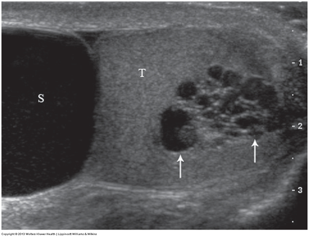 <p>What does the following describe?</p><ul><li><p><span>﻿﻿Dilatation of the efferent ductules </span></p></li><li><p><span>﻿﻿manifests sonographically as multiple tiny cystic tubules located within or adjacent to the mediastinum testis</span></p></li><li><p><span>﻿﻿With color Doppler, dilated tubules are avascular and fluid filled</span></p></li></ul>