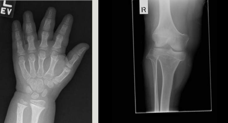 <ul><li><p>fetal US can show shortened limbs and enlarged head</p></li><li><p>genetic test can confirm diagnosis</p></li><li><p>long bones appear short and thick with a wide metaphysis</p></li><li><p>long fibula </p></li><li><p>bowing legs</p></li></ul><p></p>