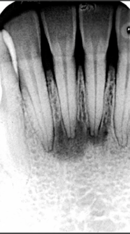<p>periapical <strong>radiolucency</strong> of VITAL tooth </p>