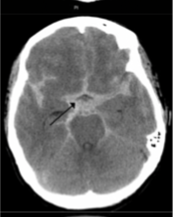 <p>What type of intracranial hemorrhage is characterized by thunderclap HA, neck stiffness, star signs on CT and xanthochromia on lumbar puncture</p>