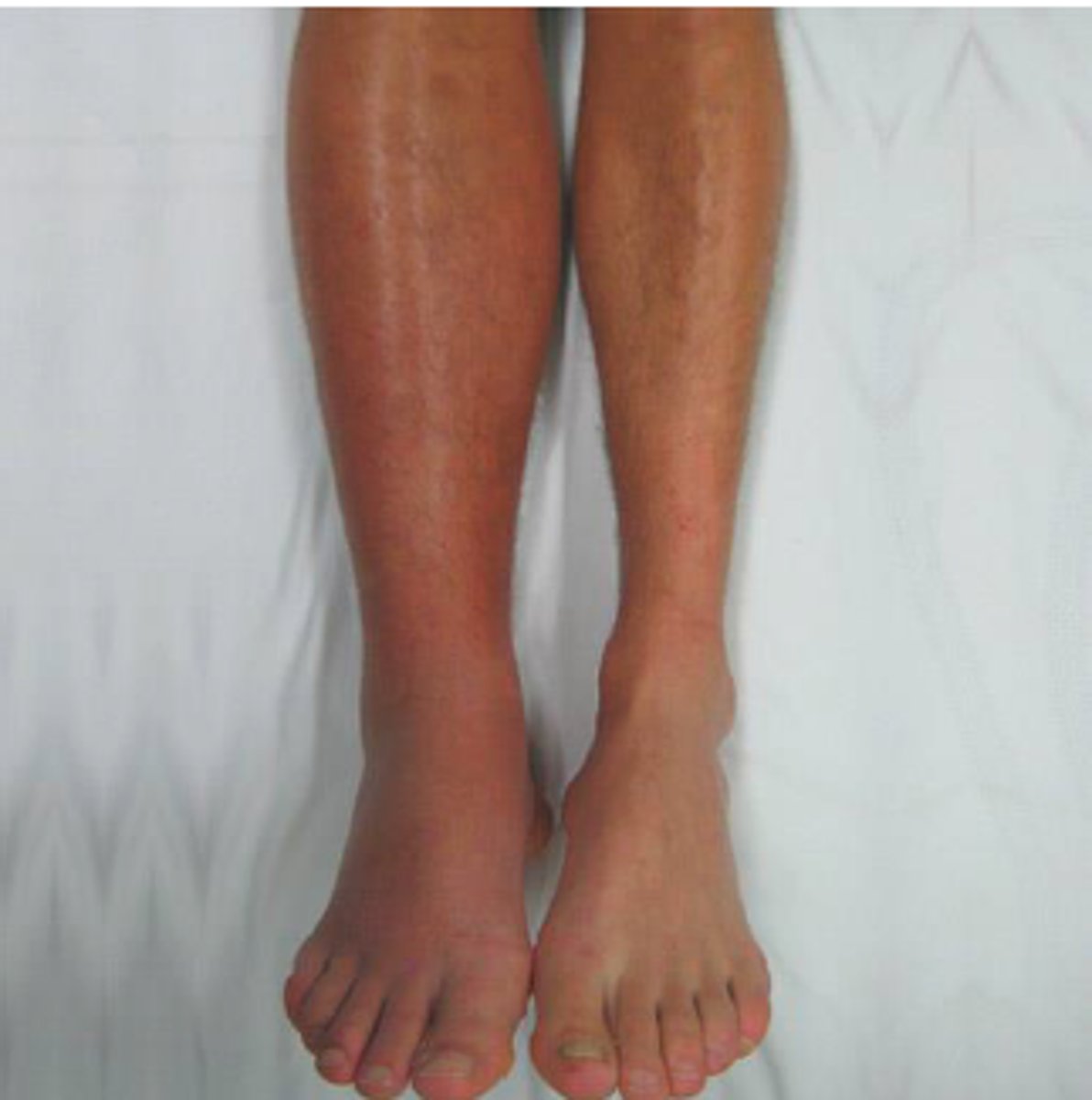 <p>-unilateral calf or groin pain</p><p>-swelling</p><p>-hot</p><p>-rednesss/erythema</p>