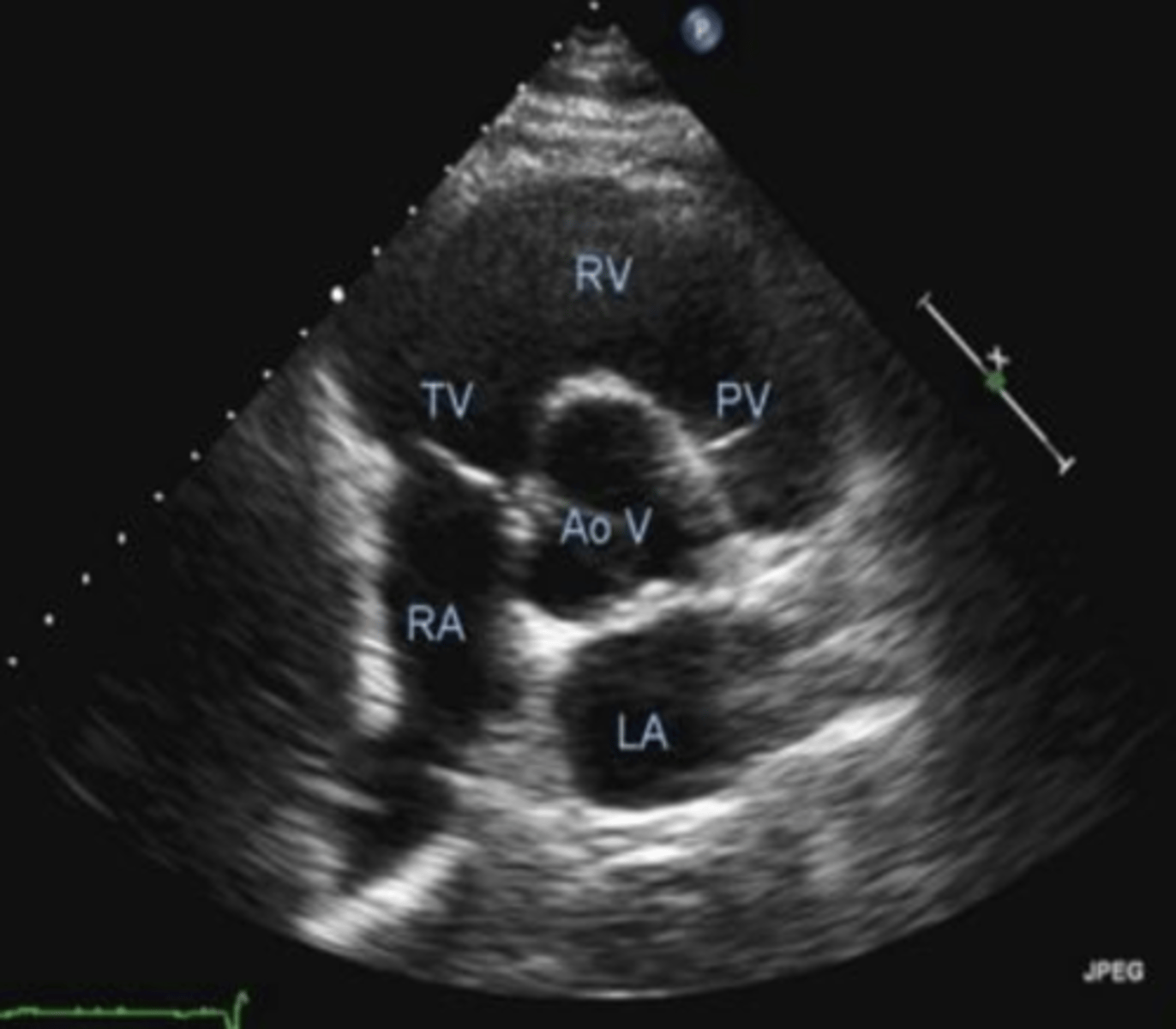 <p>PSSA AoV is used to visualize _____, ____, and ___</p>