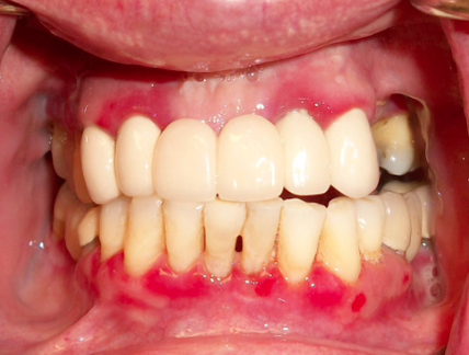 <p>What does MMP mainly affect?</p>