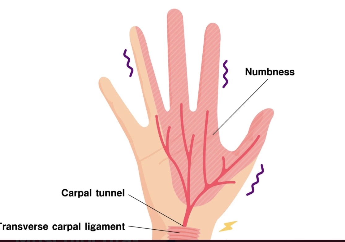 <p><span>This is an example of which nerve's sensory distribution site?</span></p>