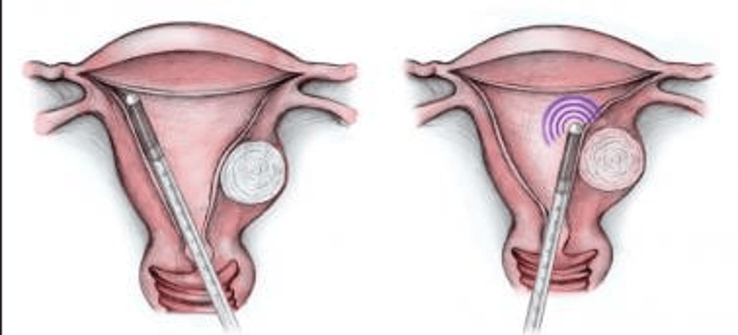 <p>-a light-sensitive substance is applied to endometrial tissue</p><p>-a laser probe is then inserted through the cervix</p><p>-the absorption of laser light by the tissue causes the endometrium to slough</p><p>-in contrast to being removed with a surgical curette</p>
