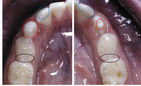 <ul><li><p><mark data-color="purple" style="background-color: purple; color: inherit;">Classic pattern of dental erosion</mark></p></li><li><p>Central depression of dentin surrounded by elevated enamel</p></li><li><p>Seen on:</p><ul><li><p>Occlusal cusp tips </p></li><li><p>Incisal edges </p></li><li><p>Marginal ridges</p></li></ul></li></ul><p></p>