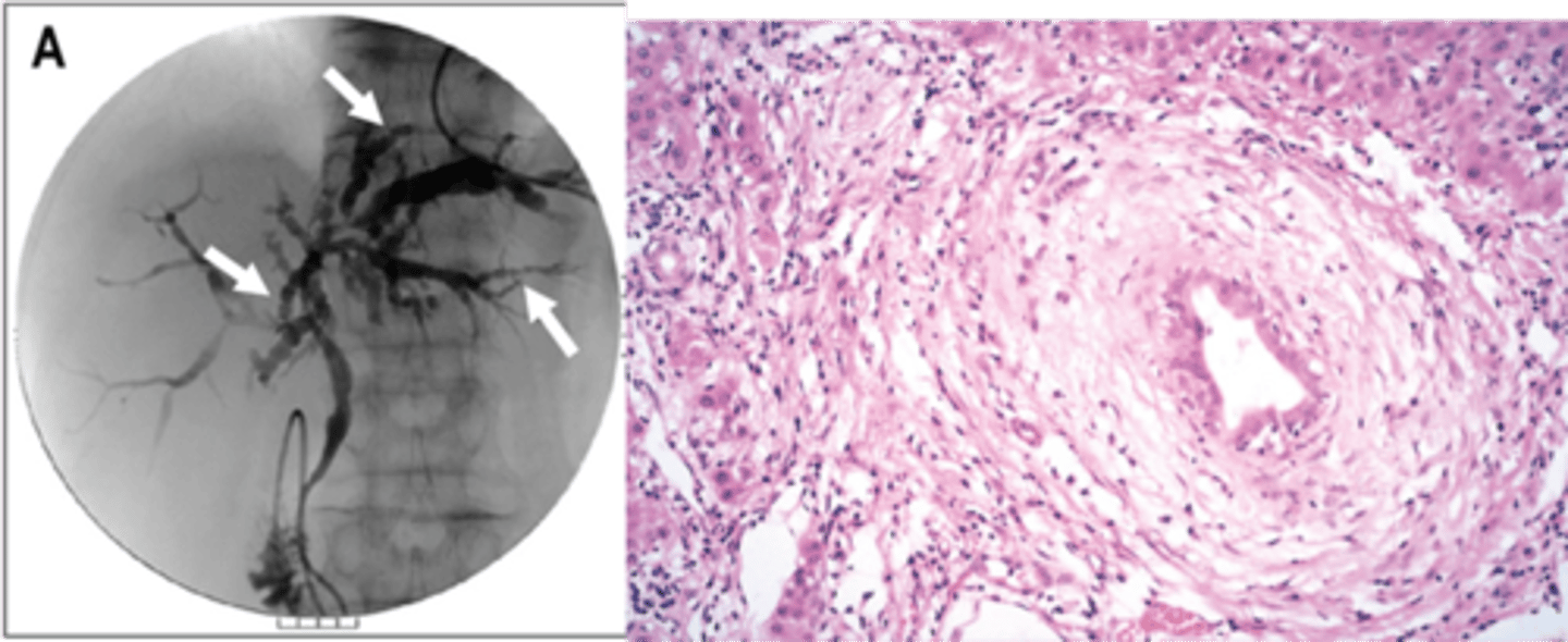 <p>Define Condition:</p><p>Autoimmune condition causing inflammation and obliterative fibrosis of intrahepatic and extrahepatic bile ducts</p><p>-Hx:</p><p>&gt; More in MALES</p><p>&gt; Strong a/w Ulcerative Colitis</p><p>-Sx/PE:</p><p>&gt; Fatigue</p><p>&gt; Pruritus</p><p>&gt; Jaundice</p><p>-Dx:</p><p>&gt; (+) MPO-ANCA/p-ANCA (80%)</p><p>&gt; Gross:</p><p>&gt;&gt; End-Stage = Cirrhosis</p><p>&gt; Biopsy:</p><p>&gt;&gt; Large bile ducts with acute &amp; chronic inflammation</p><p>&gt;&gt; Small ducts have little inflammation but show circumferential "onion skin" fibrosis and atrophic duct lumen --&gt; duct obliteration --&gt; fibrosis/cholestasis ==&gt; Cirrhosis</p><p>&gt; Cholangiogram: confirms Dx</p><p>&gt;&gt; ERCP &amp; MRCP</p><p>&gt;&gt; Shows alternating strictures and dilation "beading" of intra- and extrahepatic bile ducts</p><p>-Prog:</p><p>&gt; Chronic Pancreatitis/Cholecystitis d/t extrahepatic bile duct involvement</p><p>&gt; Median Survival = 10-12 yrs</p><p>&gt; Increased risk of Cholangiocarcinoma and HCC</p>