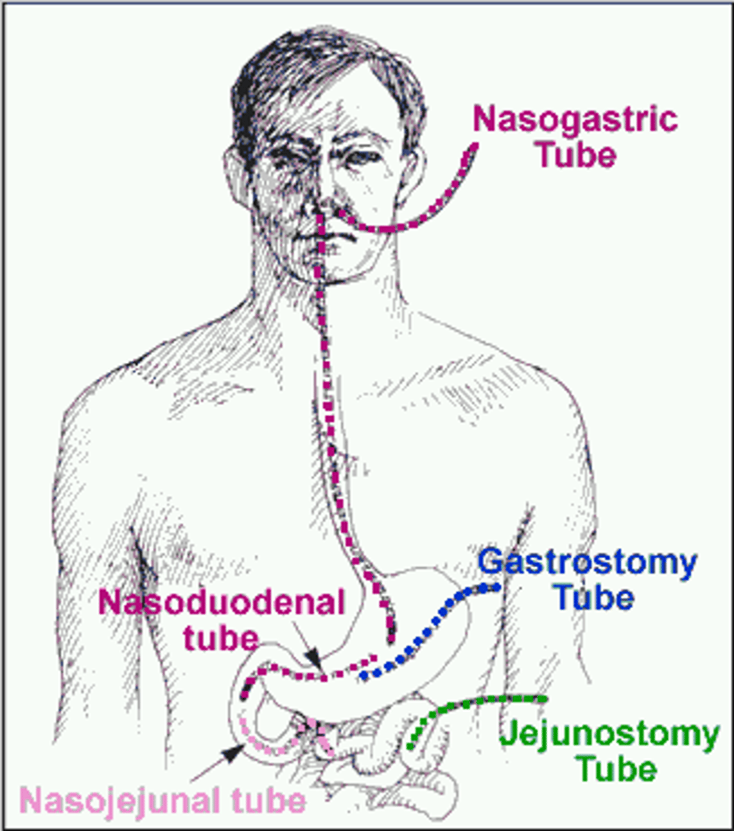 <p>-GI tract is functional</p><p>-inability to consume adequate nutrition orally</p><p>ex: anorexia, neck surgery, burns, trauma, IBD, demyelinating diseases</p>