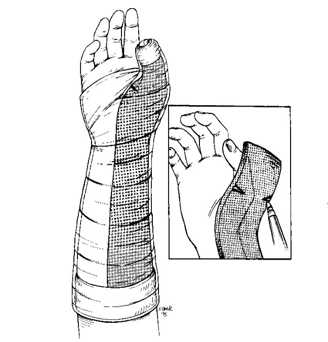 <p><strong>What are indications for thumb spica splints?</strong></p>