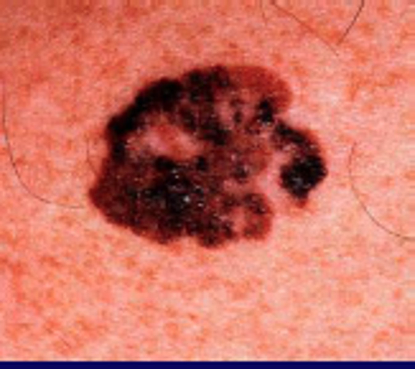 <p>-most common type of melanoma (70-80% of cases)</p><p>-typically on sun-exposed skin</p><p>-men: head, neck, trunk</p><p>-women: arms and legs</p><p>-UV radiation, genetics are RF</p><p>-remains thin for a while, then grows vertically</p>