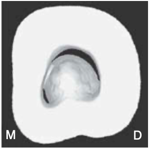 <p><span>only </span><span style="color: red;"><span>one mesial, striplike dentin </span></span><span>connection exists between the peninsula-like floor and the M wall</span></p><p><span>which separates the C-shaped groove into a small ML orifice and a large MB-D orifice</span></p><p><strong><span>MB-D </span></strong><span>orifice was formed by the merging of the MB orifice and the D orifice (</span><span style="color: red;"><span>second most common</span></span><span>)</span></p>