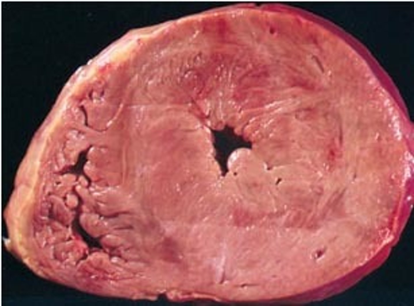 <p>concentric hypertrophy</p>