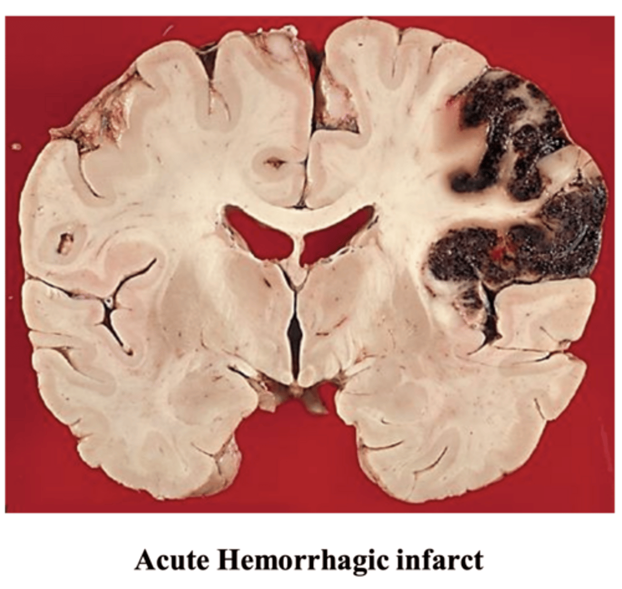 <p>smaller lacunar infarct</p>