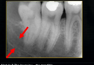 <ul><li><p>created by inferior dental nerve and blood vessel, created by the <strong>inferior dental canal </strong></p></li><li><p>the edges of the canal can be seen as thin, white radiopaque lines → ‘tram lines’</p></li></ul><p></p>