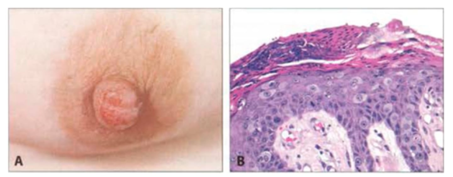 <p>Paget disease of the breast (sign of underlying neoplasm)</p>