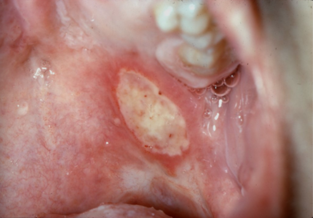 <p>Case 11. A 21 year old female with a painful ulcer on soft palate that has appeared before and disappeared after 10 days. 11a. What would be the diagnosis?</p>