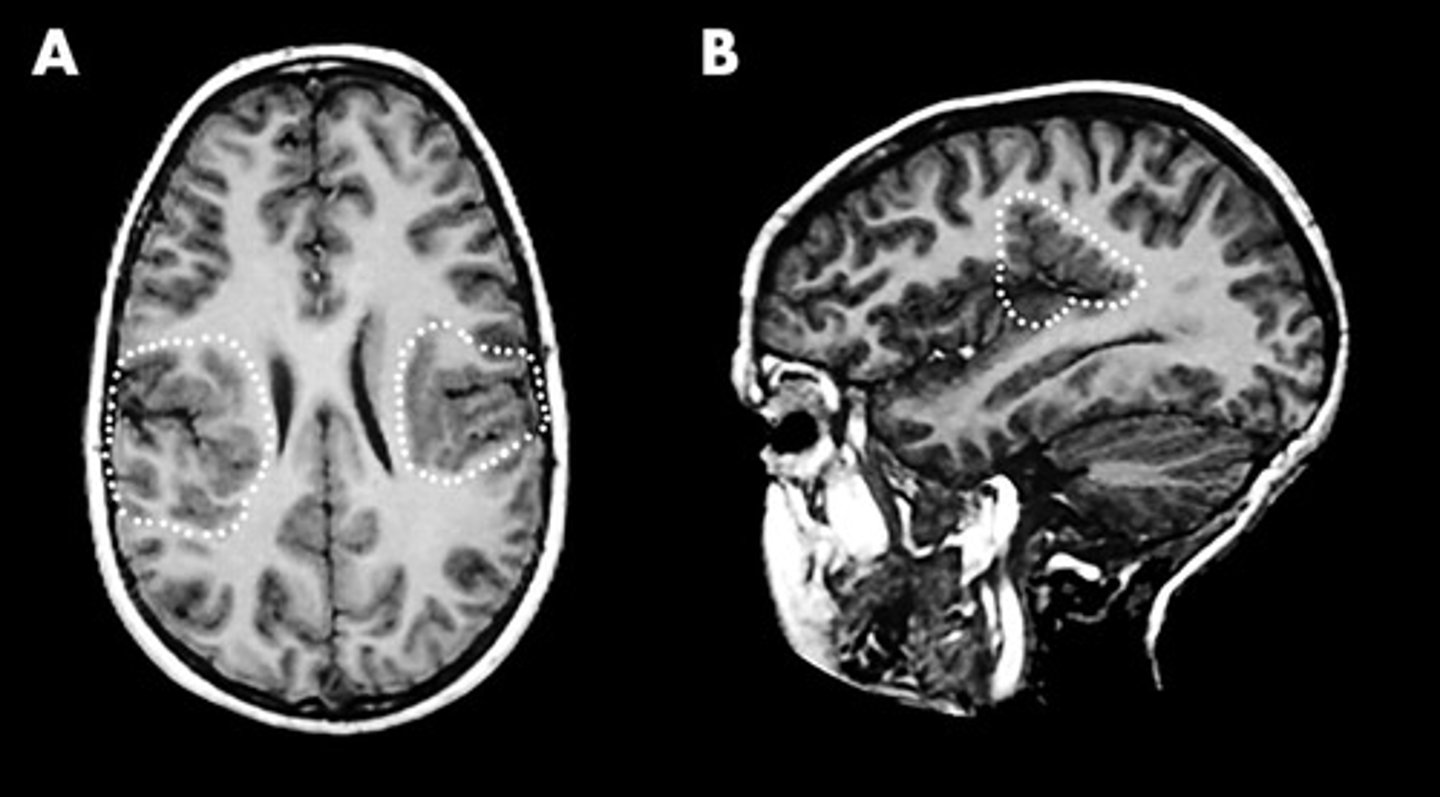 <p>Define Polymicrogyria</p>