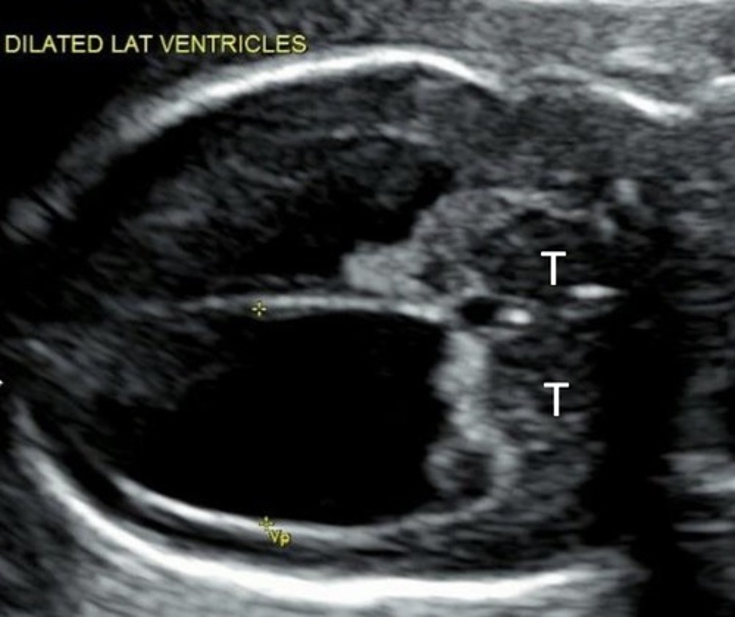 <p>Single ventricle</p><p>Fusion of the thalamus</p><p>Partial formation of occipital horns</p><p>Remaining falx</p>