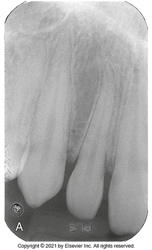 <p><span>Is seen as a thin, radiolucent area adjacent to the root and the lamina dura of the bone.</span></p>