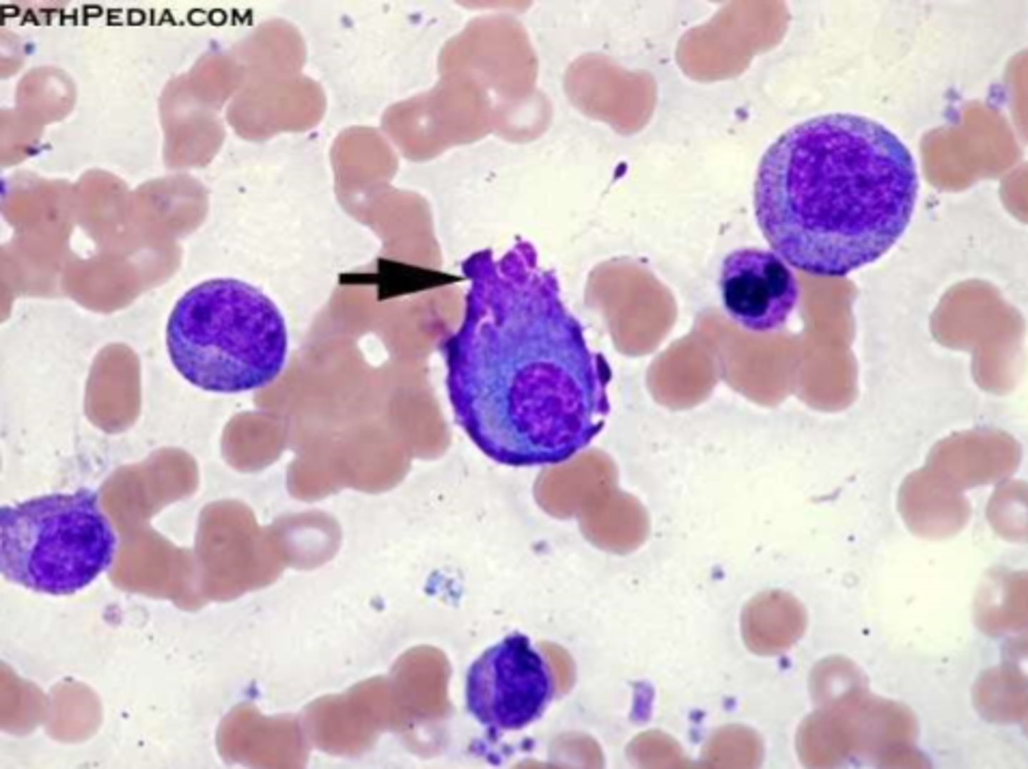 <p>-Flame cells <br>-More Ig than other plasma cells</p>