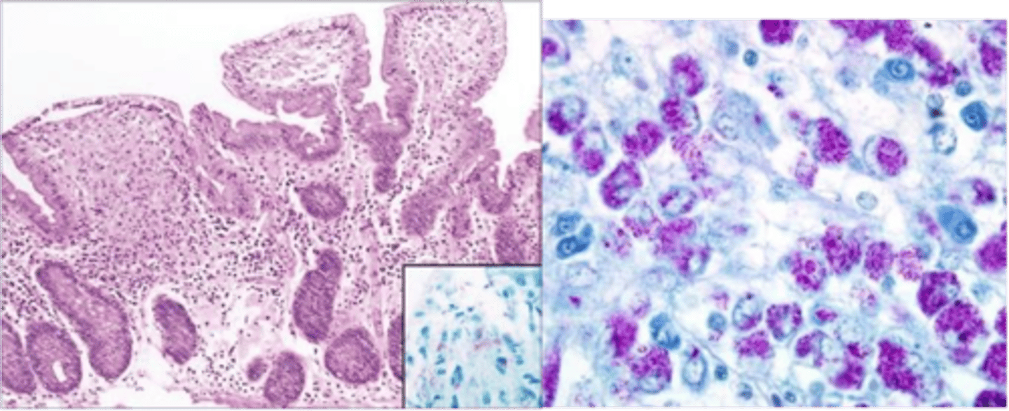<p>Define Condition:</p><p>Defect of lymphatic transport caused by Systemic infex d/t MAC (atypical mycobacterial infex/nonTB mycobacteria) made of M. avium and M. intracellulare</p><p>-Hx:</p><p>&gt; Immunocompromised (HIV/AIDS)</p><p>-Path: MC Sites = Small Bowel &amp; Large Bowel</p><p>-Sx/PE:</p><p>&gt; Fever</p><p>&gt; Diarrhea</p><p>&gt; Malabsorption</p><p>&gt; Loss of Appetitie</p><p>&gt; Weight Loss</p><p>-Dx:</p><p>&gt; Watery Diarrhea w/o fecal WBCs</p><p>&gt; PAS (+) and diastase-resistant + (+) Ziehl Neelsen Acid Fast Stain </p>