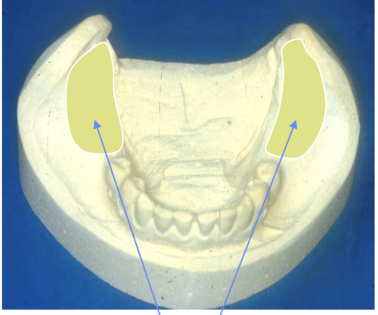 <p>Kennedy classification:</p><p>- bilateral edentulous area posterior to natural teeth</p>