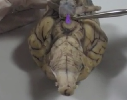 <p>Infundibulum</p>