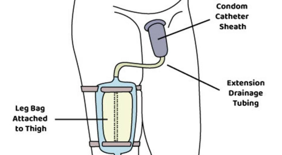 <p>def. catheter used for incontinent males. </p>