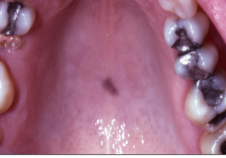 <p>a benign, localized area of increased MELANIN in the oral mucosa</p>