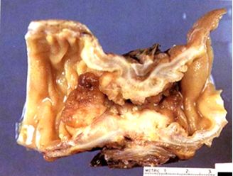 A 73-year-old man has noted a change in bowel habits for the past year. Defecation is more difficult, and the caliber of stools has decreased. On physical exam, there are no abnormal findings except for stool positive for occult blood. Colonoscopy is performed for the first time in this man, followed by colonic resection with the gross appearance shown in the figure. Which of the most likely diagnosis of this lesion