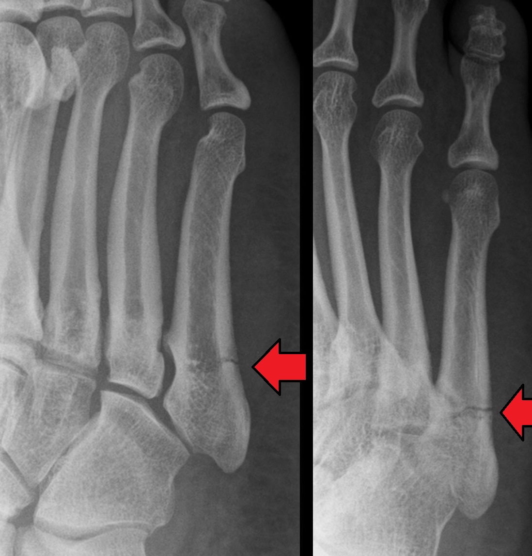 <p>What kind of fracture is shown?</p>