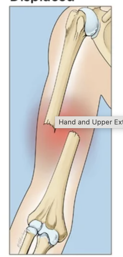 <p>Bone breaks into<strong>&nbsp;2 or more pieces</strong> and the pieces<strong> shift out of alignment</strong></p>