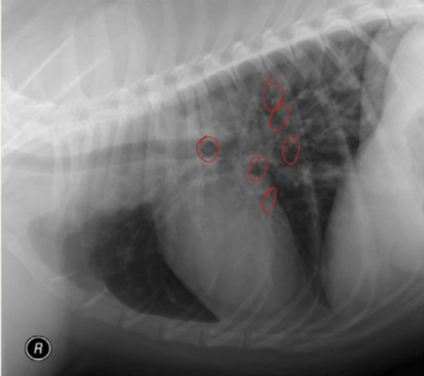 <p>- opacidad ↑ generalizada del espacio intersticial o peri-bronquial</p><p>- patrón bronquial de "donuts"</p><p>- hiperinsulfación</p>