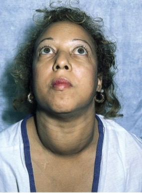 <p>leads to hyperthyroidism</p>