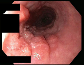 <p><strong>Esophageal Cancer: Symptoms and Diagnosis</strong></p><p>-Symptoms: progressive _________, weight loss, odynophagia, iron deficiency ______</p><p>-Diagnosis: EGD with _______, contrast CT or ___ scan </p><p>-Staging Evaluation: endoscopic __<strong> </strong>for locoregional staging. Can also do CT with contrast or ___ scan to look for distant metastasis. </p>