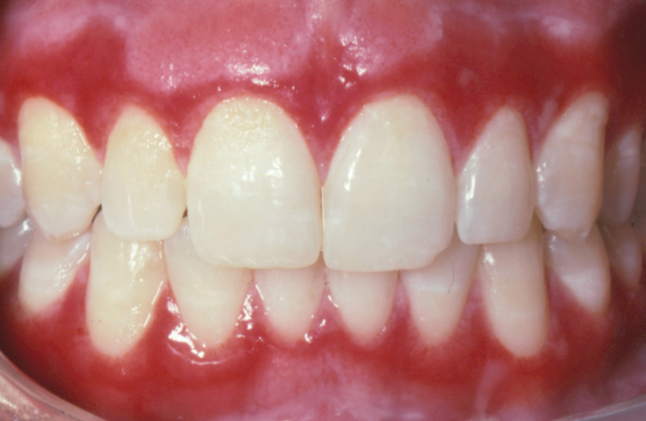 <p>3b. Which of the following is the correct differential diagnosis?</p><p><span><span>Primary herpetic gingivostomatitis, erosive LP, lichenoid mucositis</span></span></p><p><span><span>Erosive LP, systemic lupus, erythema multiforme</span></span></p><p><span><span>Pemphigus vulgaris, mucous membrane pemphigoid, erosive LP </span></span></p><p><span><span>Mucous membrane pemphigoid, reticular LP, pemphigus vulgaris</span></span></p>