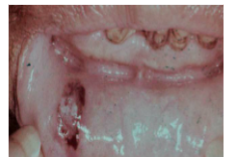 <p><span style="background-color: transparent; font-family: "Times New Roman", serif;">*Bacterial infections, malaise, sore throat, fever (a few days after drug is taken)</span><br></p><p><span style="background-color: transparent; font-family: "Times New Roman", serif;"><u>ORAL</u>:</span></p><p><span style="background-color: transparent; font-family: "Times New Roman", serif;">*<strong>Necrotizing, punched-out, deep mucosal ulcerations </strong></span></p><p><span style="background-color: transparent; font-family: "Times New Roman", serif;"><strong> - buccal mucosa, tongue, palate</strong></span></p><p><span style="background-color: transparent; font-family: "Times New Roman", serif;"> - sparse inflammation and abundant bacterial colonies</span></p><p><span style="background-color: transparent; font-family: "Times New Roman", serif;">*<strong>Gingivitis resembling necrotizing ulcerative gingivitis (NUG)</strong></span></p>