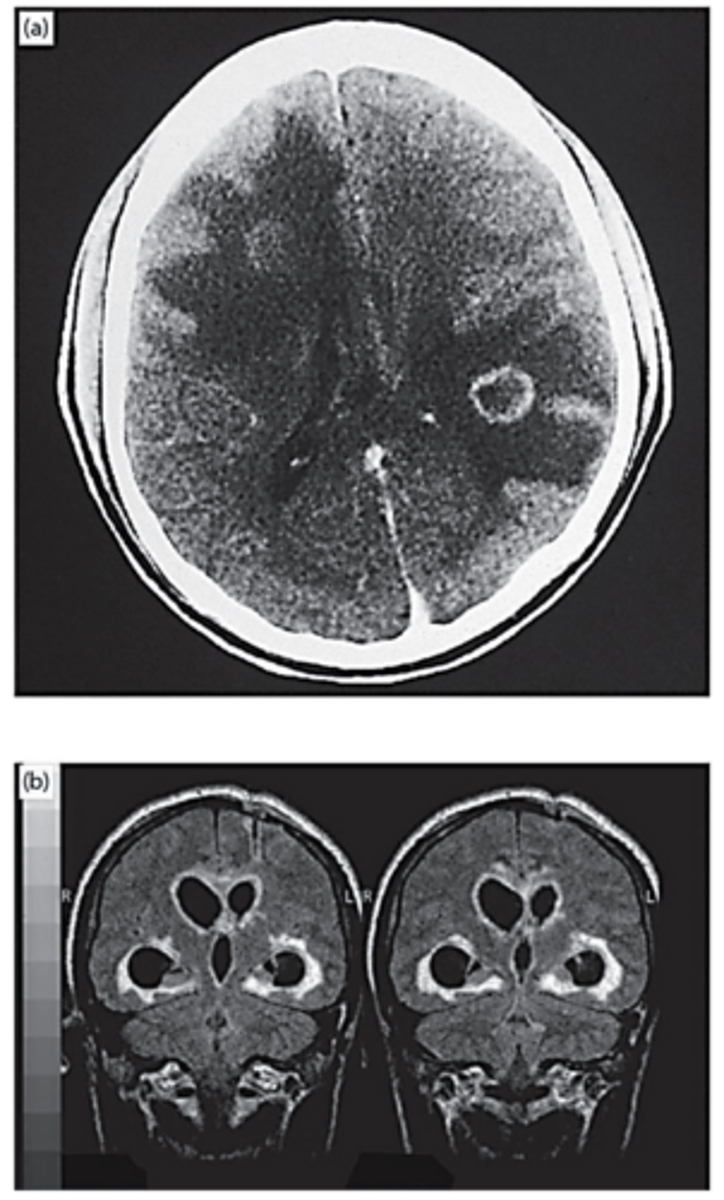<p>a) CT scan of typical cerebral mass lesion with ring-enhancing lesion and surrounding edema</p><p>b) MRI scan showing less common periventricular pattern of infection -> histopathology showed necrosis to a depth of 1 cm, with abundant ziotes</p>