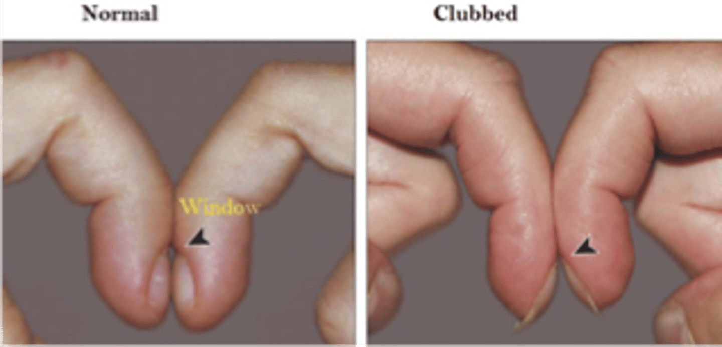 <p>◦The distal phalanx of each finger is rounded and bulbous</p><p>- commonly seen in pts with underlying lung issues</p>