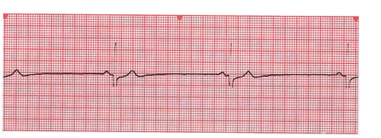 <p>what rhythm is this?</p><p>Rate is less than 60</p><p>rhythm is regular</p><p>P wave is present</p><p>QRS is 0.04-0.12-normal</p><p>PR is 0.12-0.2 normal</p><p>causes: meds-BETA BLOCKERS, digoxin, narcotics, athletes.</p><p>S/S: dizzy, tired, syncope, orthostatic hypotension</p><p>TX: take time to change positions, drink caffiene, pace maker, increase fluids, decrease/DC meds</p><p>for a SYMPTOMATIC patient: give atropine</p>