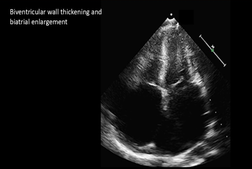<ol><li><p>Normal LV size </p></li><li><p>Biventricular hypertrophy </p></li><li><p>Significant biatrial enlargement </p></li></ol><p></p>