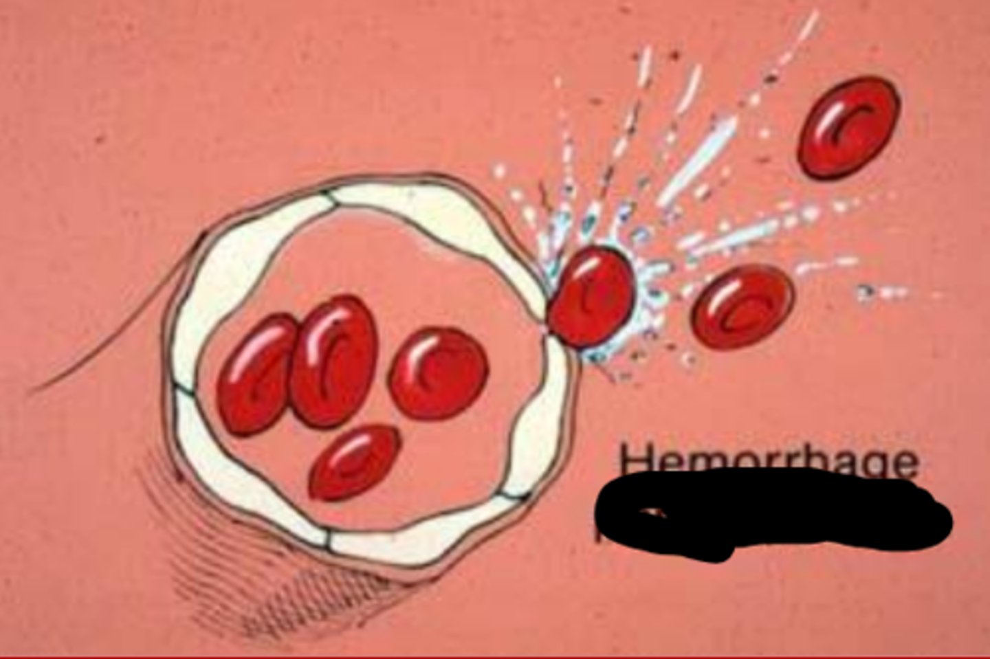 <p>Hemorrhage by "leaping through" or squeezing out of vessels</p>