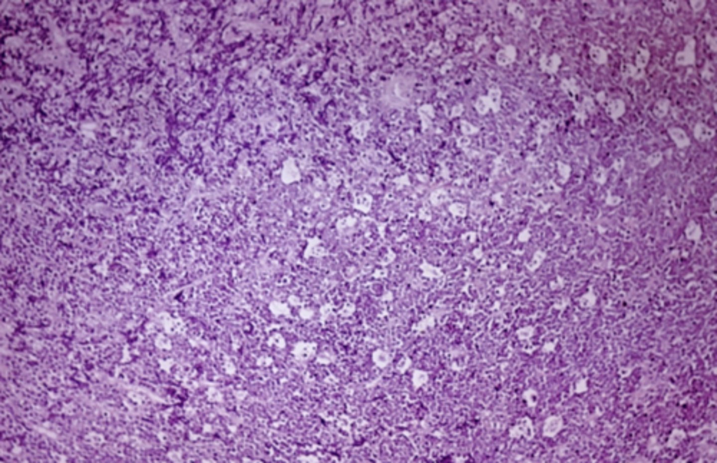 <p>malignant lymphocytes --> "starry sky"</p>