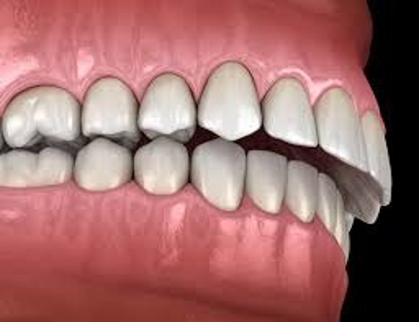 <p>overbite</p>
