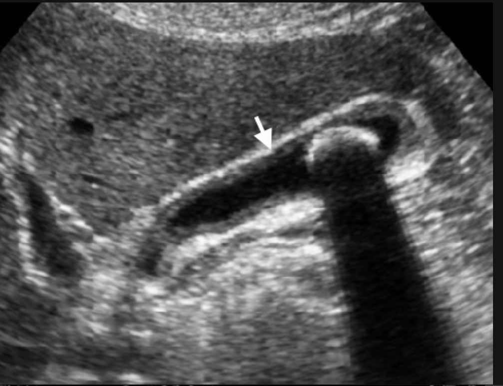 <p>L<span>ong-standing inflammation, fibrosis; often associated with stones </span></p><p><span>Thick fibrotic wall, contracted GB, stones, no hyperemia; WES sign </span></p>