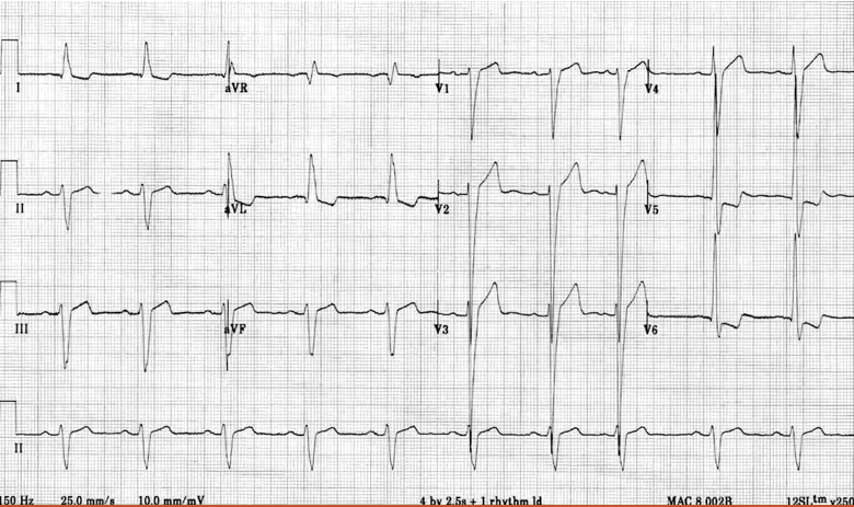 <p>What kind of heart problem is this + how to spot it?</p>