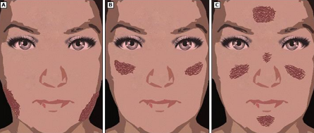 <p><strong>Clinical Manifestations of Melasma</strong></p><p>-Irregular, light-brown to gray-brown _________ and ________ on sun exposed skin </p><p>-Lesions are usually __________ and may affect face and neck, spare the lips/ears/periorbital skin </p><p>-____________: affects the forehead, cheeks, nose, upper lip, and chin</p><p>-Malar: involves lateral _______ areas</p><p>-Mandibular: affects lower __________</p>