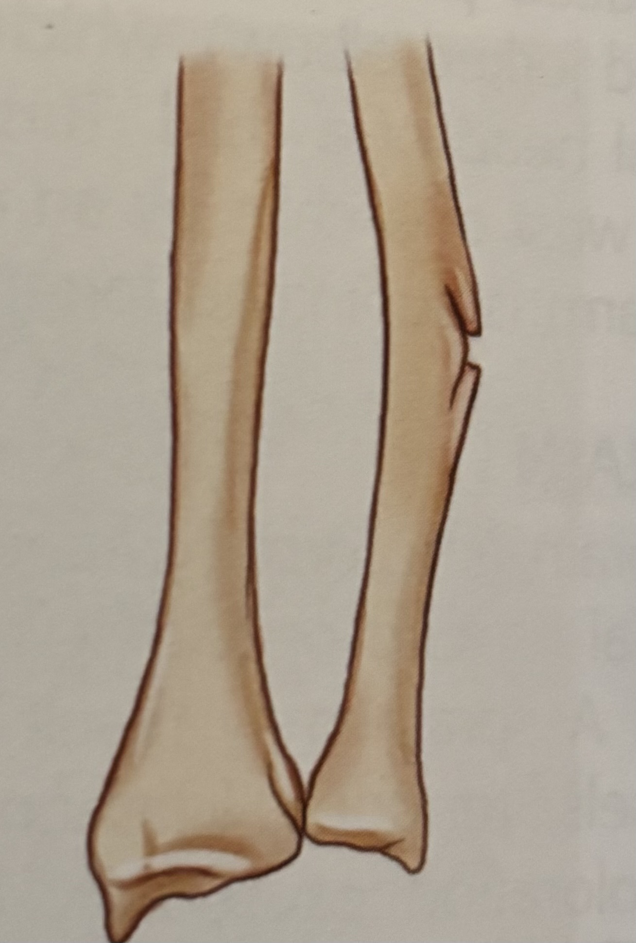 <p>What type of fracture is this?</p>