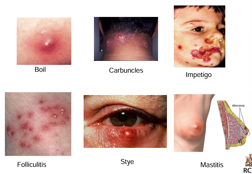 <p>boils are superficial infections where you get a collection of pus - can be spontaneously draining or be encouraged by a warm moist compress. recurrent may need antibiotic treatment</p><p>folliculitis is a superficial skin infection involving hair follicles - treatment not always needed</p><p>furuncles and carbuncles are deeper infections usually preceded by folliculitis - common on hairy skin. spontaneous or surgical draining needed. patients can be systemically unwell with carbuncles</p><p>S. aureus s the most likely pathogen</p>
